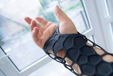 Elindeki toz 3D yazıcıya basılmış siyah ortopedik plastik protez. Ortopedik alçıtaşı kol hizasında..