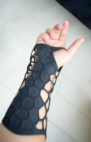 Prótesis plástica ortopédica negra impresa en la impresora 3D en polvo a mano. El yeso ortopédico está en primer plano del brazo. — Foto de Stock