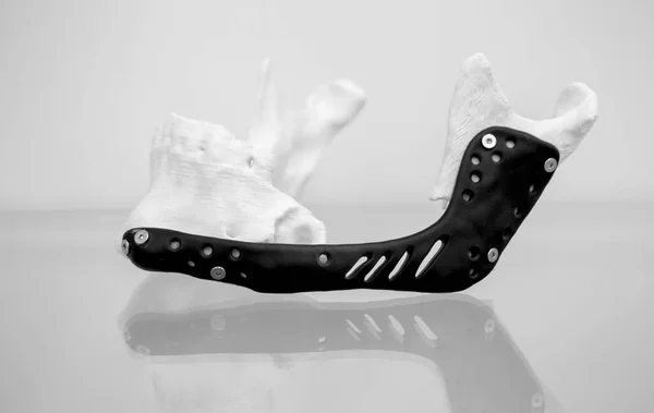 Impianto di endoprotesi della mandibola. Modello stampante 3D stampata mascella inferiore — Foto Stock
