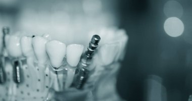 Yakın plan implantları olan şeffaf İnsan Dişleri Modeli