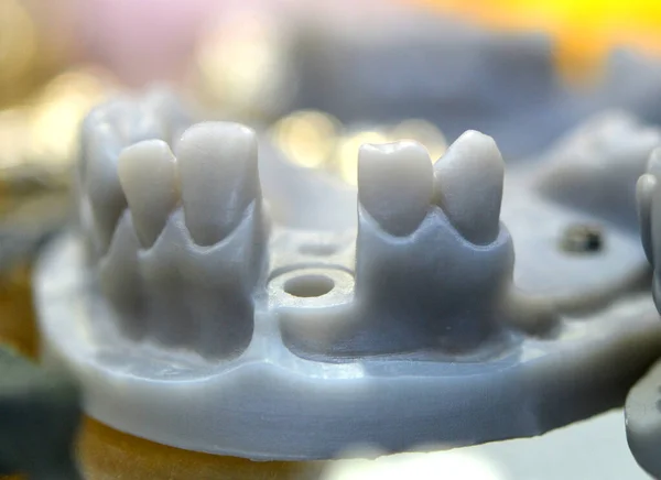 Collapsible jaw model with teeth and holes for the implant crown abutment printed on a 3d printer — Stock Photo, Image