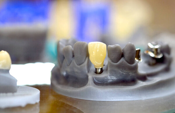 Collapsible jaw model with teeth and holes for the implant crown abutment printed on a 3d printer