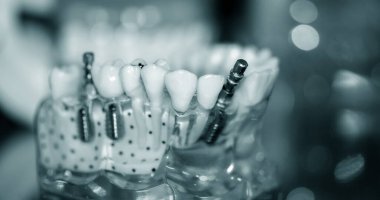 Yakın plan implantları olan şeffaf İnsan Dişleri Modeli