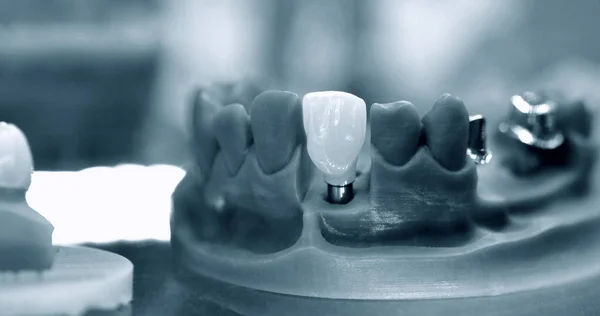 Katlanabilir çene modeli implant başlığı için dişler ve delikler — Stok fotoğraf