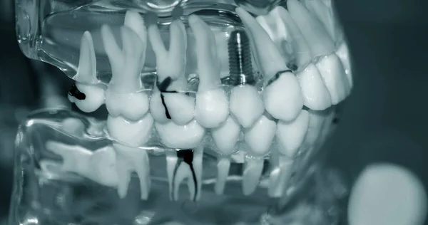 Modelo transparente de dientes humanos con implantes de primer plano —  Fotos de Stock