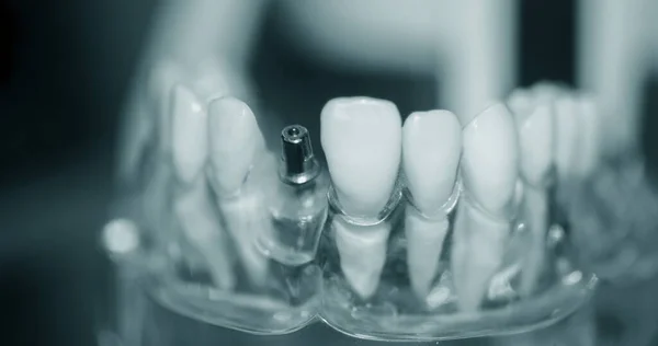 Transparent Model of Human Teeth with implants close-up — Stock Photo, Image