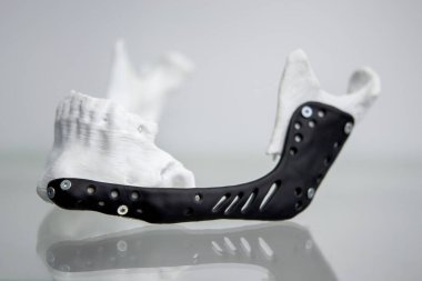 Alt çene endoprotezinin yerleştirilmesi. 3B yazıcıya yazdırılmış çene modeli