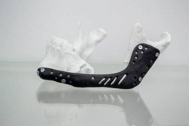 Alt çene endoprotezinin yerleştirilmesi. Alt çene modeli 3D yazıcı beyaz plastiğine basılmış. Metal biyouyumlu titanyum alaşımlı siyah renk için 3D yazıcıya basılmış endoprotez.
