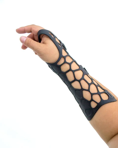 Orthopedische Plastic Prothese Gedrukt Poeder Printer Hand Geïsoleerd Witte Achtergrond — Stockfoto