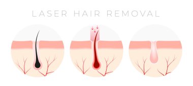 IPL Laser saç temizleme verctor illüstrasyon kavramı