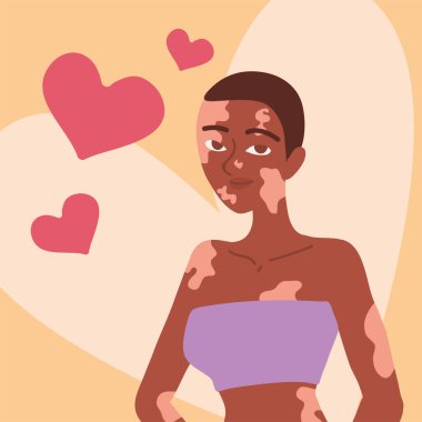 beautiful woman character with vitiligo