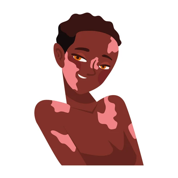 Afro Woman Vitiligo Diversity Inclusion — Stockvektor