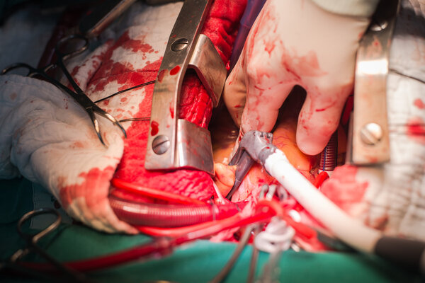 Bipolar in left side block atrial fibrillation mitral valve repair operation
