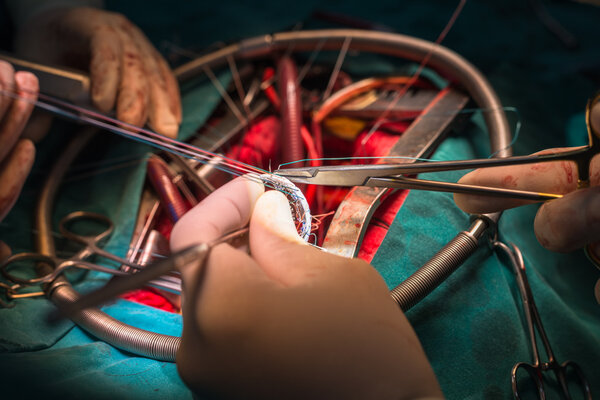 Suture valve ring in mitral valve repair operation