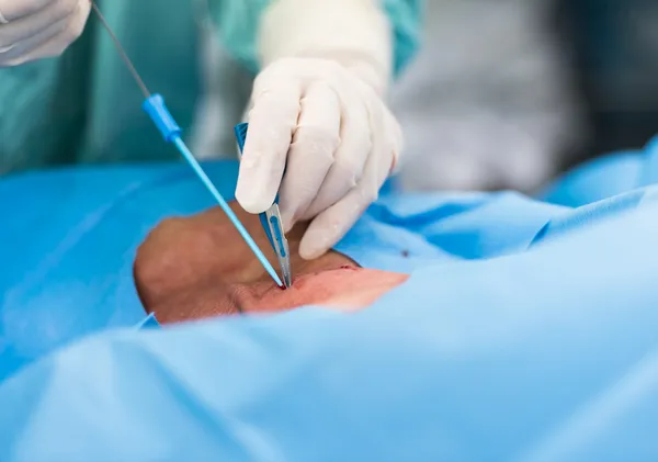 Merkezi Venöz basınç için iç karotis damarı ponksiyon