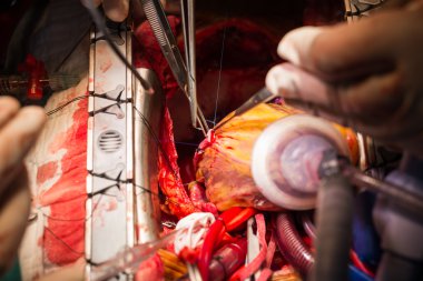 Coronary artery bypass grafting obtuse marginal artery anastomosis clipart
