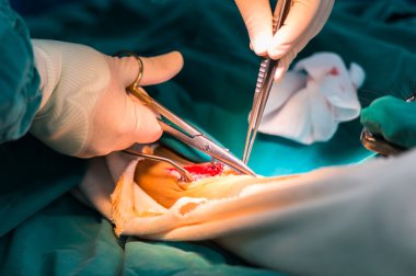 büyük Safen ven hasat için Venöz kanalı