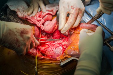 Abdominal aort anevrizması