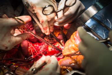 Abdominal aort anevrizması açın ve kanamayı durdurmak