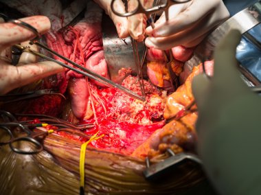 Abdominal aort anevrizması açın ve kanamayı durdurmak