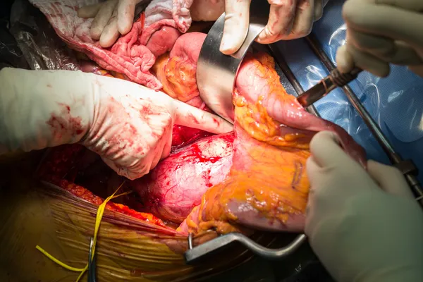Abdominal aortic aneurysm — Stock Photo, Image