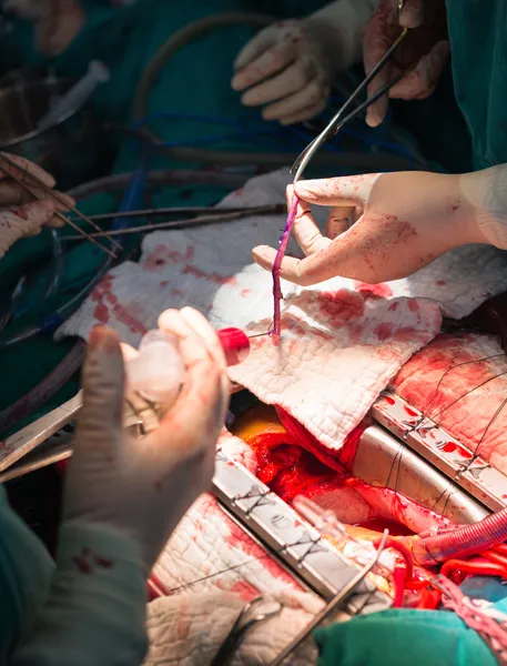 Mayor preparación de la vena safena para la anastomosis en la arteria coronaria —  Fotos de Stock