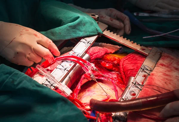 Прямая кардиоплегия крови через трубопровод — стоковое фото
