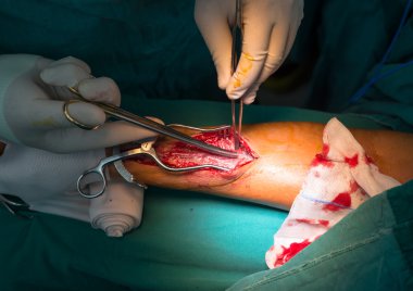 hasat için Koroner atardamar kanal için Radyal arter