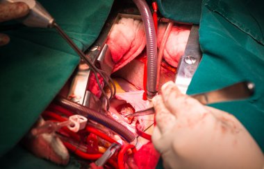 Ventriküler septal defekt aracılığıyla Triküspit kapak kapatmak