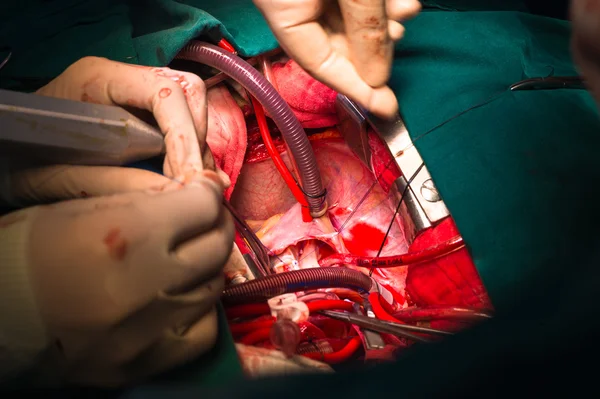 Close ventricular septal defect via tricuspid valve — Stock Photo, Image