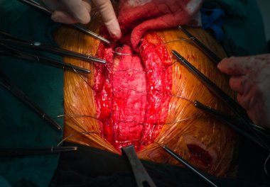 metal teller ile kapatılması sternum kemik