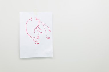 Koroner arter baypas greftleme için planlama