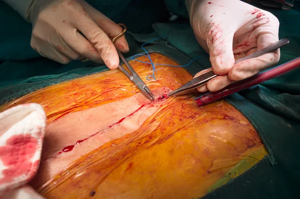 Suture close sternotomy incision — Stock Photo, Image