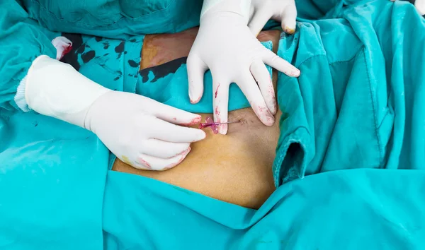 Tusuk arteri femoralis di pangkal paha untuk mengakses arteri femoralis — Stok Foto