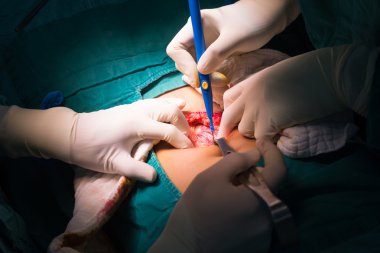 laparotomi apandisit ameliyatı için Keşfet