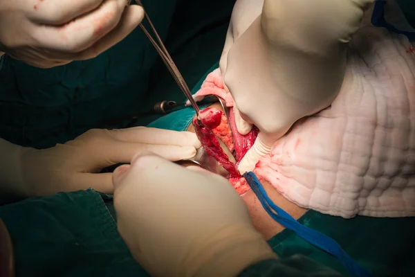 Apandisit ameliyatı için ligasyonu ek