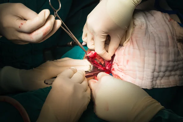 Ligation appendix for appendectomy — Stock Photo, Image