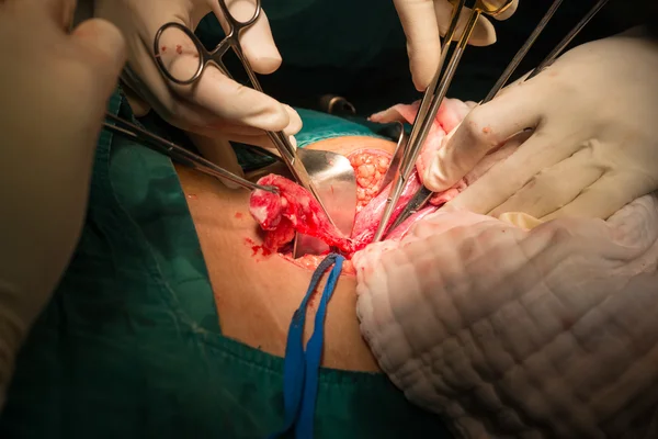 Appendectomy — Stock Photo, Image