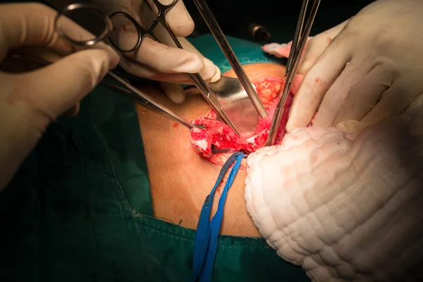 La apendicitis por ruptura explora la laparotomía a la apendicectomía — Foto de Stock