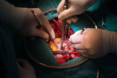 Mitral kapak onarımı yapmak neo akor tarafından