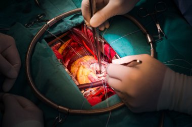 sınav mitral kapak broşürü anterior ve posterior