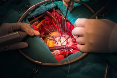 sınav mitral kapak broşürü anterior ve posterior