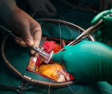 dikiş halkası annuloplasty