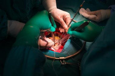 commissurotomy romatizmal mitral kapakta darlık içinde