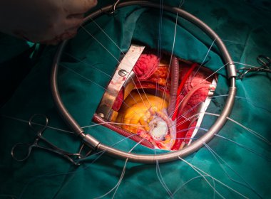 Mitral kapak onarımı sonrası