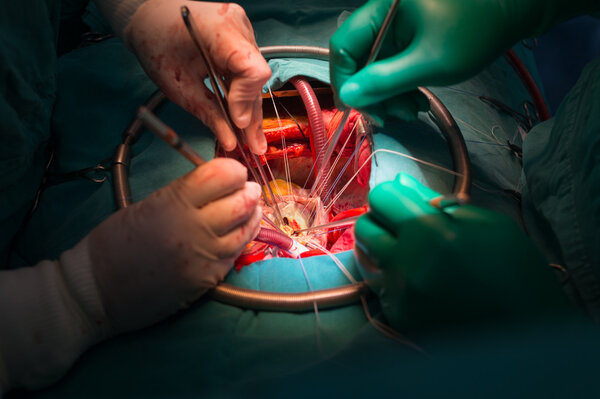 Commissurotomy in rheumatic mitral valve stenosis