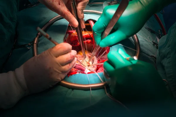 Commissurotomie dans la sténose rhumatismale de la valve mitrale — Photo