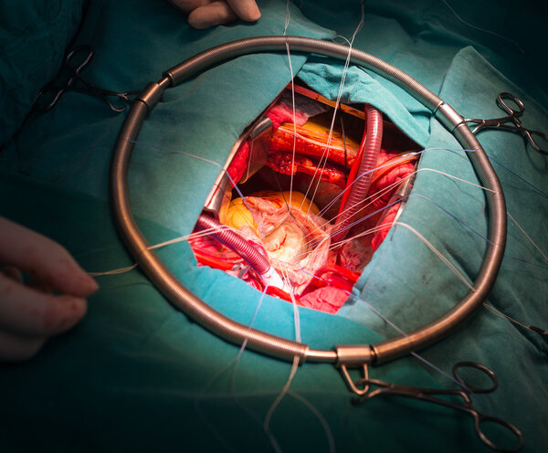 Rheumatic mitral stenosis