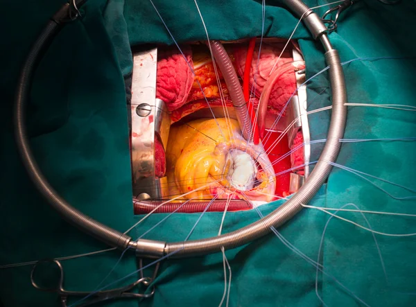 Mitral valve after repair — Stock Photo, Image