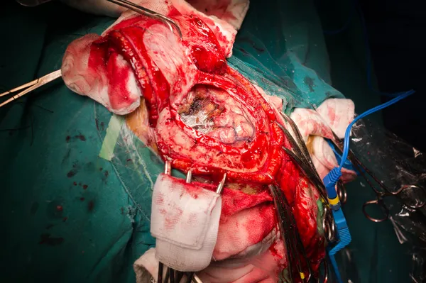 Craniectomy in case of brain tumor at frontal lobe — Stock Photo, Image